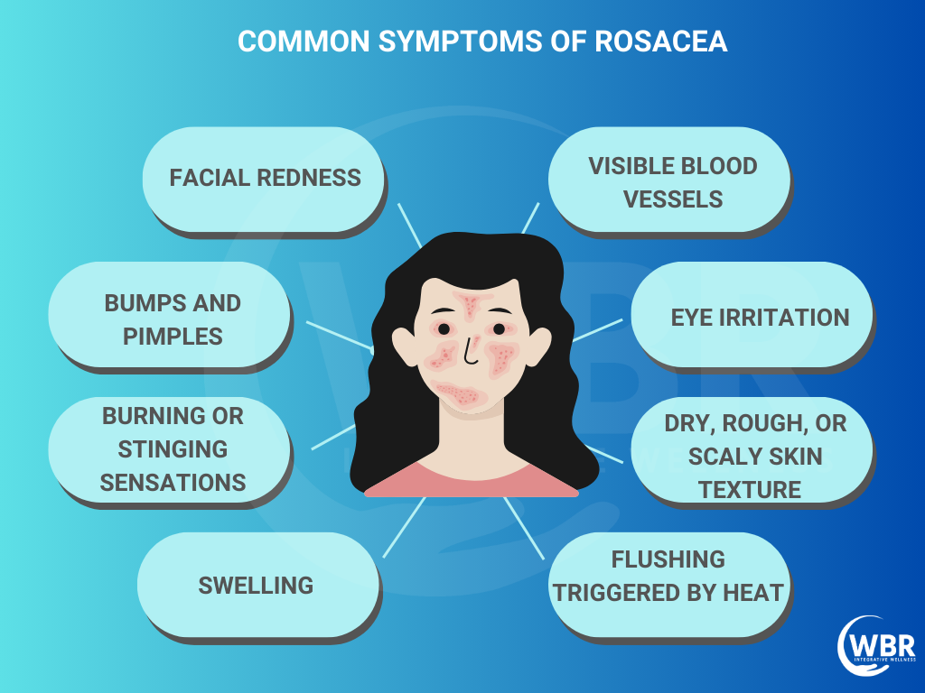 Rosacea Symptoms